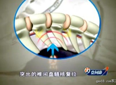 脊椎侧弯脊椎弯曲治疗仪-郑州要间康医疗科技